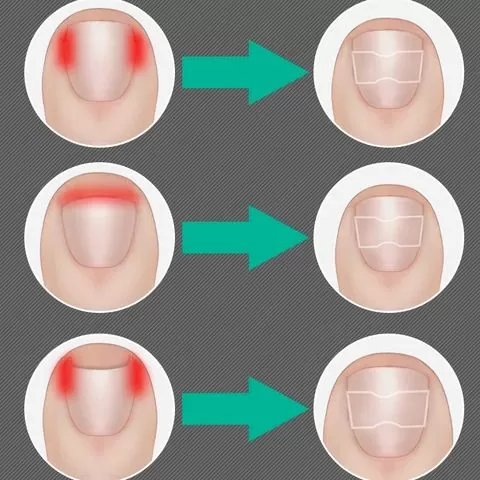 NAILPATCH 5